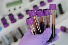 انتشار فيروس HIV في بروكسل يثير أسئلة جديدة حول الوقاية والصحة العامة