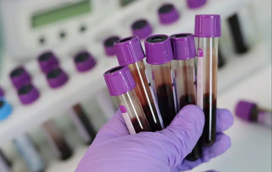 انتشار فيروس HIV في بروكسل يثير أسئلة جديدة حول الوقاية والصحة العامة